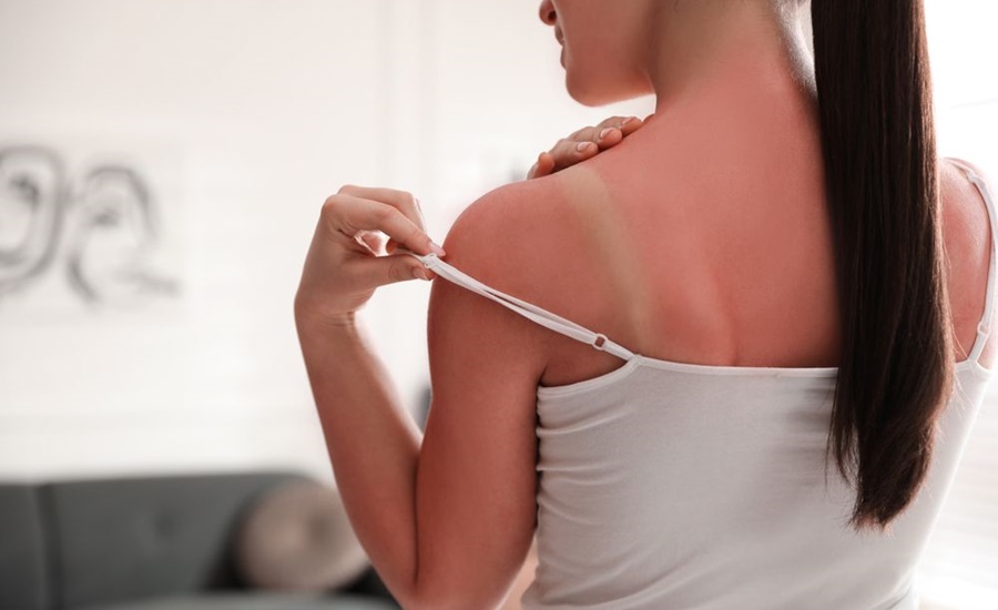 Si va a viajar, tenga cuidado con su piel