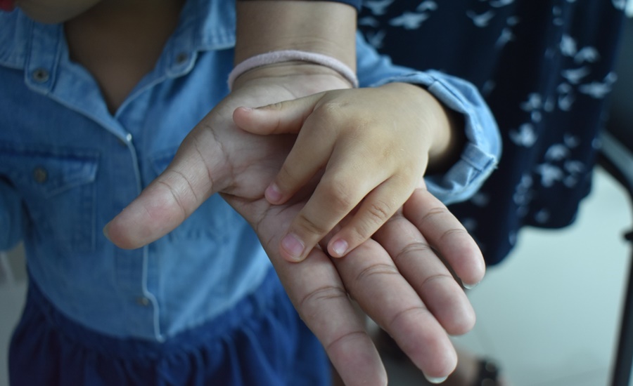 ´Manos a la obra´ atendió más de 130 casos de niños con alteraciones congénitas en sus manos