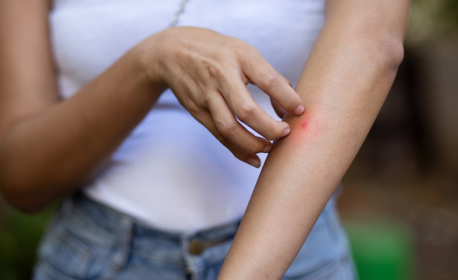 Disfrute sus vacaciones sin picaduras ni enfermedades: consejos para protegerse de la leishmaniasis