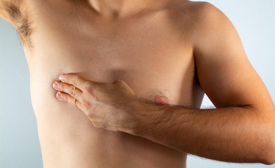 Cáncer de mama en hombres:  tener unos kilitos de más, podría ponerlo en riesgo